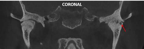 Osteoartrosis de ATM Dento Metric Radiología Dental Oral y