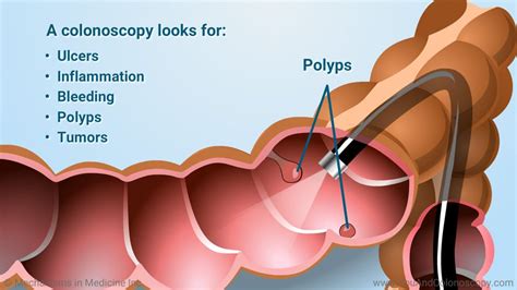 What Is A Colonoscopy And How Do I Prepare For It Colon Cleanse Tablets Colon Health