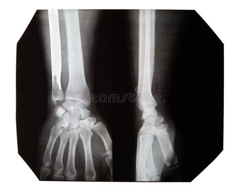 X-ray Images of a Hand with a Fracture on a White Stock Image - Image ...