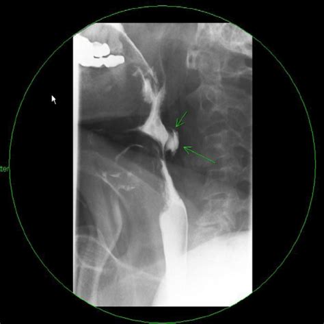 Esophagram Showing A Focal Contained Esophageal Leak Consistent With