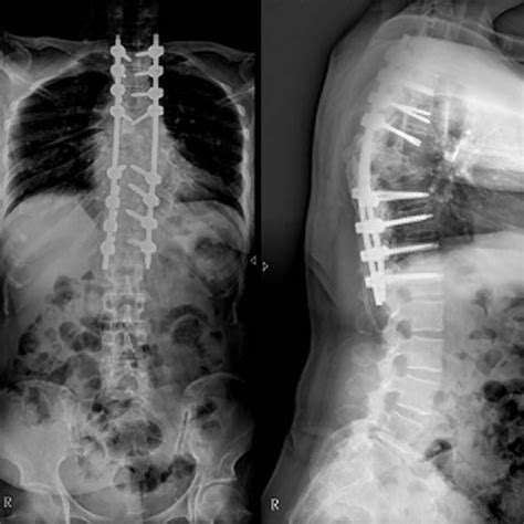 A Preoperative Standing Lateral Radiograph Showing Thoracic Kyphosis