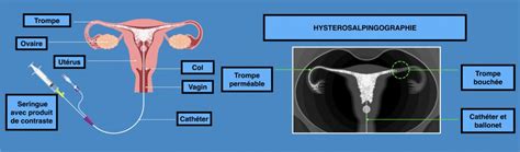 Hystérosalpingographie Centre d Imagerie Les Landes
