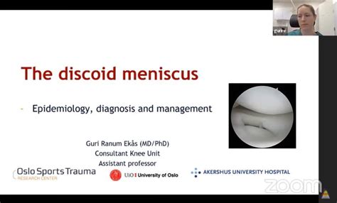 The Discoid Meniscus — OrthopaedicPrinciples.com