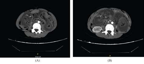 Idiopathic Jejuno Jejunal Intussusception In An Adult A Case Report