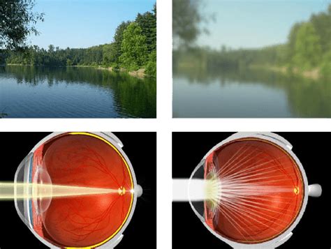 Cataract Of Staar Natuurlijk Voorkomen En Behandelen