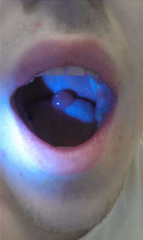 Isolated Oedema Of The Uvula Induced By Intense Snoring And Ace