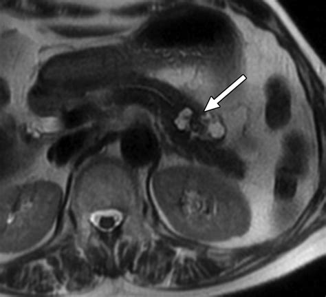 Typical And Atypical Manifestations Of Serous Cystadenoma Of The