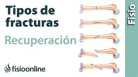 Tipos De Fracturas De Hueso Y Su Tratamiento Y Recuperación Youtube