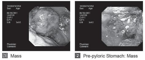 A Unique Case Of Systemic Sarcoidosis Presenting As Pseudoac