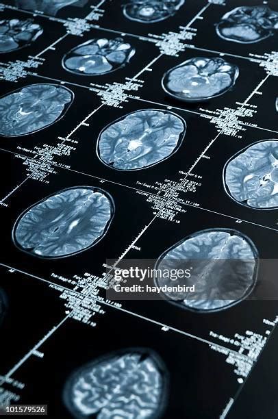 88 Migraine Brain Scan Stock Photos, High-Res Pictures, and Images ...