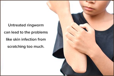 Ringworm In Kids Ways To Prevent And Treat Them