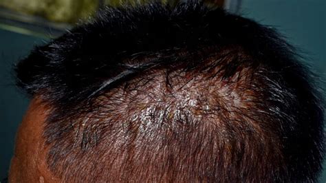 Seborrheic Dermatitis Scalp African American Hair