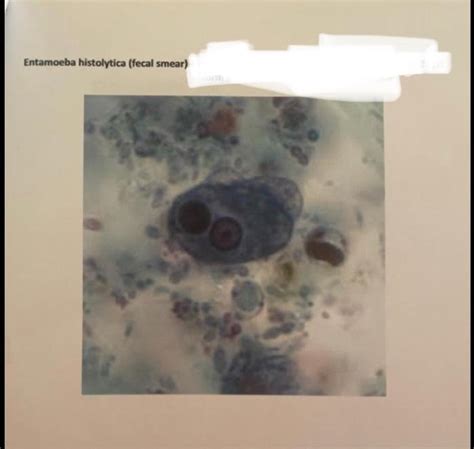 Solved Entamoeba Histolytica Fecal Smear 2 Describe The