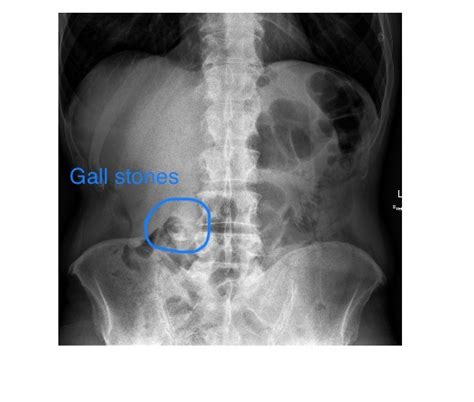 Imaging Case Of The Week 449 Answer Emergucate