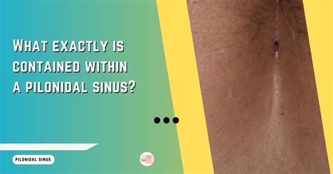 What Is Pilonidal Sinus A Comprehensive Overview