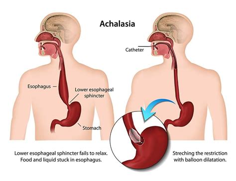 13 Gastroesophageal Reflux Disease Gerd Warning Signs And Symptoms