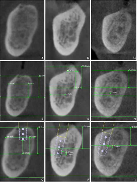 Feasibility Of Implant Placement In Healed Mandibular Molar Sites A