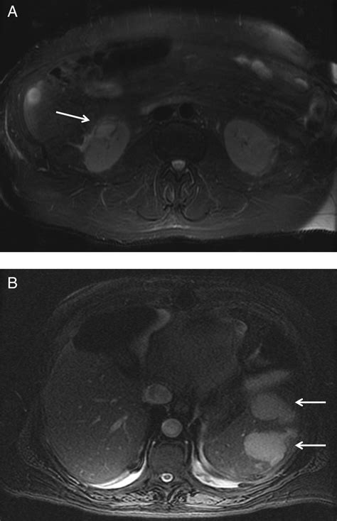 Rare Case Of Simultaneous Enterococcal Endocarditis And Prosthetic