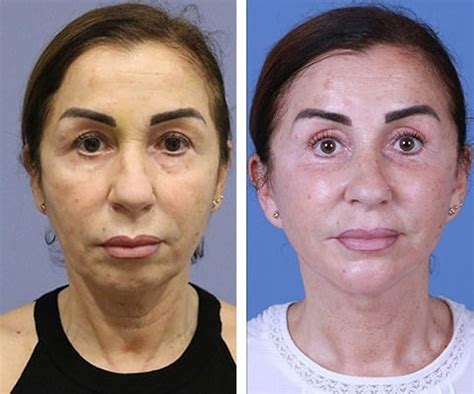 Chin Implants Procedure Providers Photos Cost Belorens