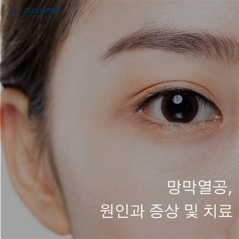 망막열공 원인과 증상 및 치료 네이버 블로그