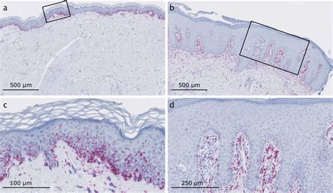 Rna Chromogenic In Situ Hybridization Cish For Cirs 7 In Lesional