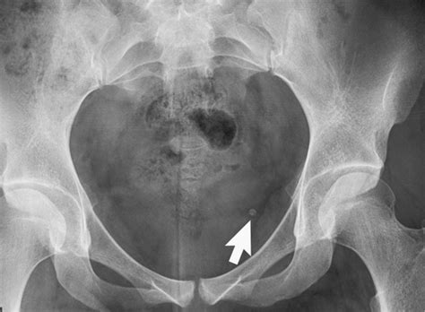 File:X-ray Of Pelvis With Idiopathic Avascular Necrosis Of, 44% OFF