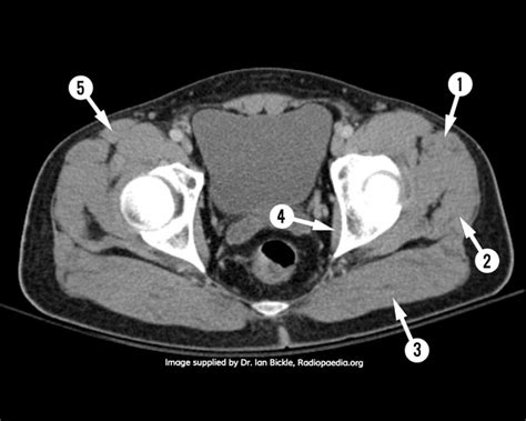 Ct Anatomy Pelvis Muscles : MRI pelvis anatomy | free male pelvis axial ...