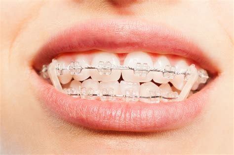 What Are Orthodontic Elastics Rubber Bands And How Do They Work