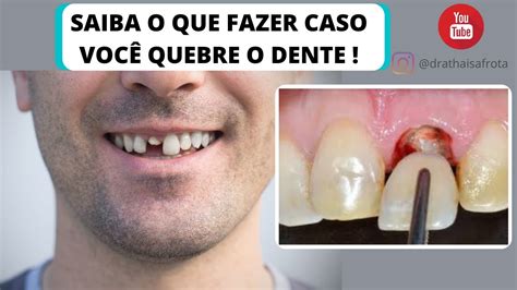 Meu Dente Quebrou Dente Quebrado Quebrei O Dente O Que Devo Fazer