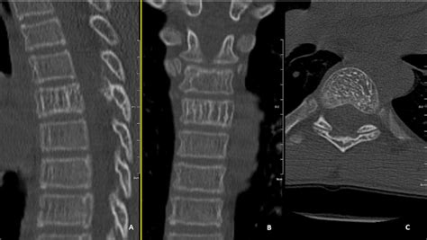 Computer Tomography Ct Image Of The Thoracic Spine Before Surgery Download Scientific