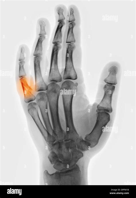 X Ray Of Hand With Fracture Of A Proximal Phalanx Stock Photo Alamy