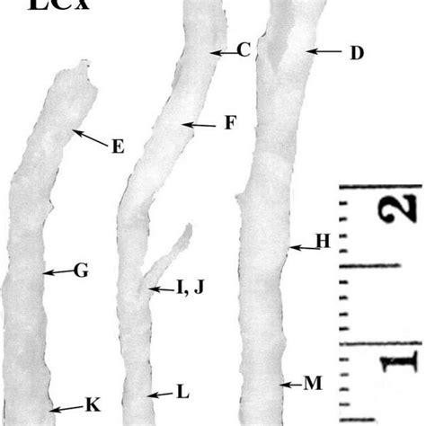 Different artery atheroma features are represented on coronary artery ...