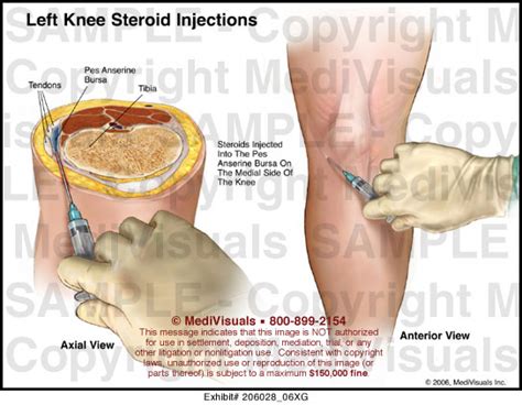 Left Knee Steroid Injections Medical Exhibit