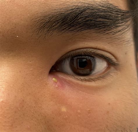 Got a pimple growing under my eye : r/mildlyinfuriating