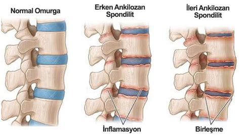 Ankilozan Spondilit Tedavisi Sanal Hastane