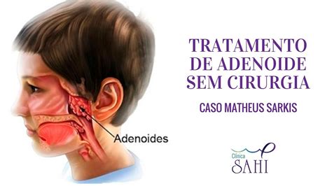 Tratamento De Adenoide Sem Cirurgia YouTube