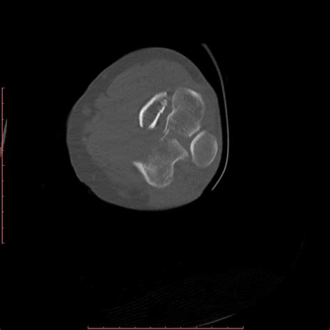 Displaced T Condylar And Supracondylar Fracture Of The Distal Humerus