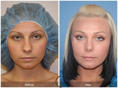 Rhinoplasty Before And After Bulbous Tip