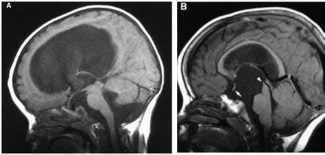 Prenatally Diagnosed Suprasellar Arachnoid Cyst When To Treat