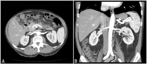 3D Reconstructions A C Obtained By A Combined Nephro Urographic