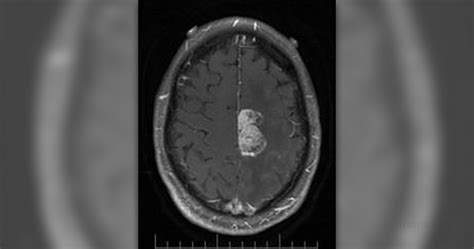 Multiple sclerosis: Diagnosing MS with MRI | Musculoskeletal Issues ...