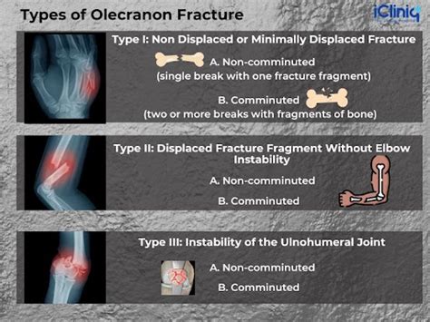 What Is an Olecranon Fracture?