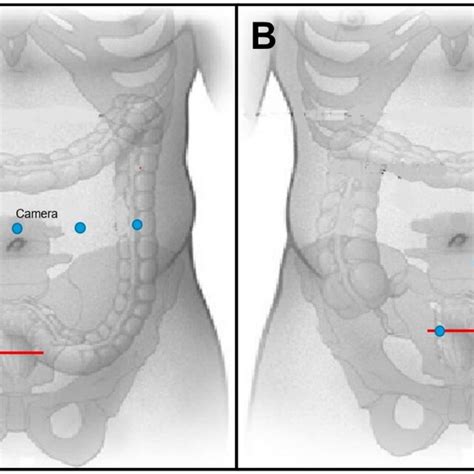 Diagram Of Two Robotic Port Placement Arrays For Combined Colorectal