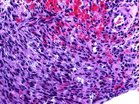 Pathology Outlines Kaposi Sarcoma