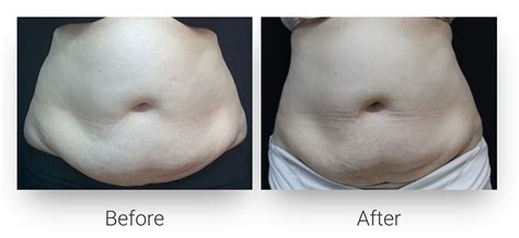 Body Contouring Vida Lift Clinic Center