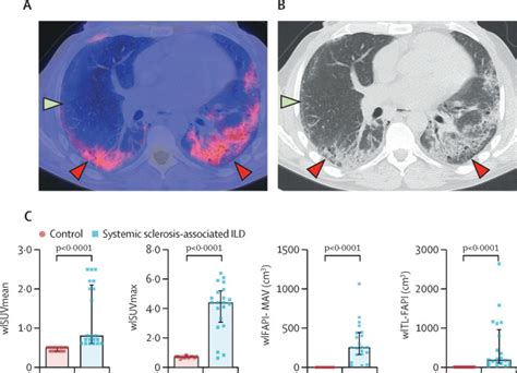 Ga Fapi Pet Ct For Molecular Assessment Of Fibroblast Activation