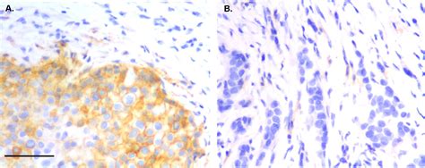 Figure 1 From PD L1 And Intratumoral Immune Response In Breast Cancer