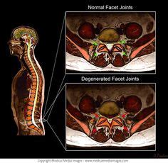 7 Lumbar Facet Joints shown on Color X-Rays and MRI Scans ideas | lumbar, medical medium, x ray