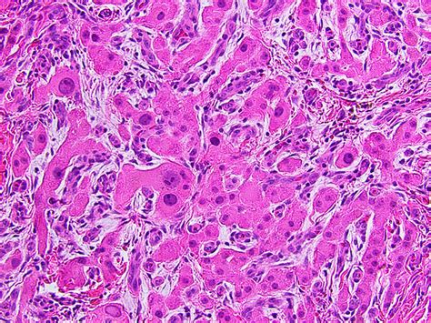 Case 65 Bilateral Testicular Swellings In A Young Male Pathology