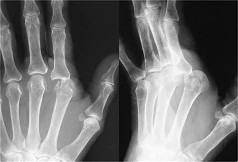 Radiography showing dorsal dislocation of the MP joint. | Download ...